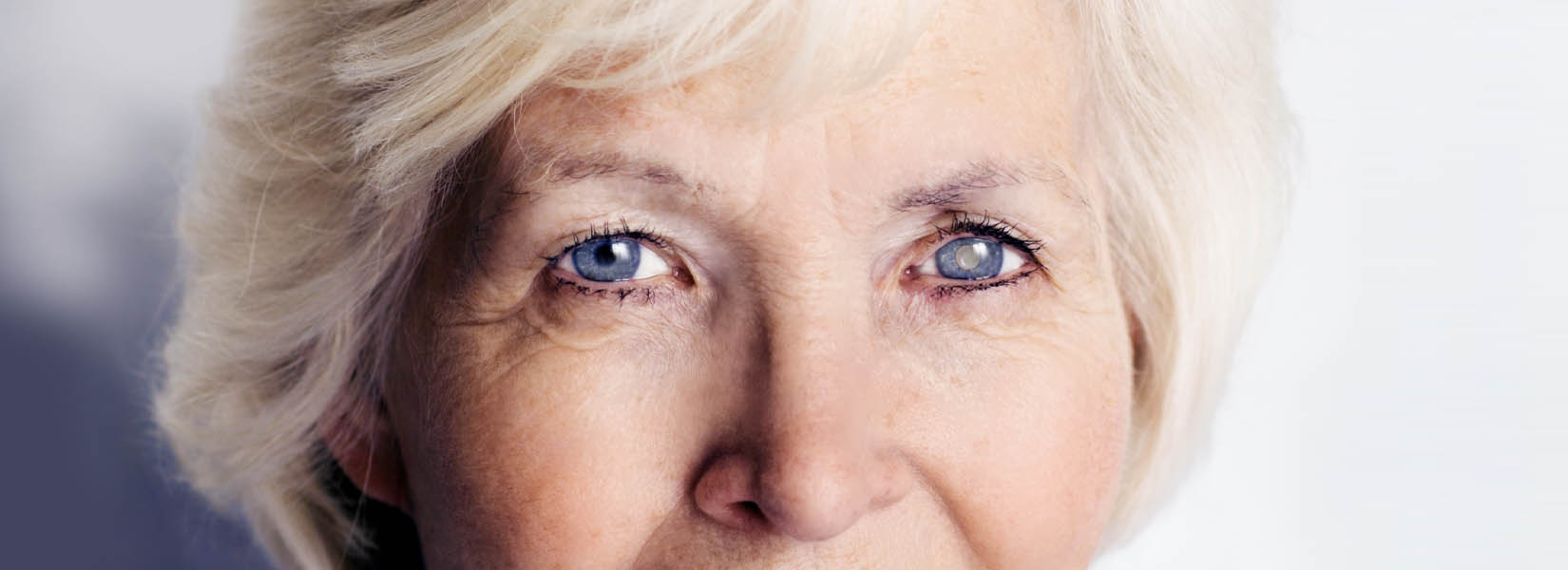 Cataract Surgery in Carondelet